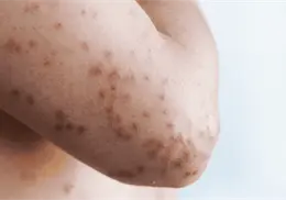 Michoac&aacute;n confirma la primera muerte por sarampi&oacute;n en 2026