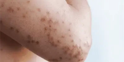 Michoac&aacute;n confirma la primera muerte por sarampi&oacute;n en 2026