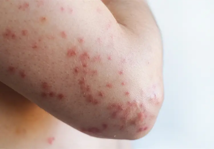 Michoac&aacute;n confirma la primera muerte por sarampi&oacute;n en 2026