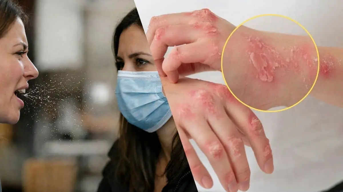 Autoridades sanitarias en M&eacute;xico alertan sobre los s&iacute;ntomas del sarampi&oacute;n y recomiendan medidas de prevenci&oacute;n en los municipios afectados