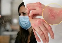 &iquest;Tienes fiebre y manchas? Estos son los primeros s&iacute;ntomas del sarampi&oacute;n en M&eacute;xico