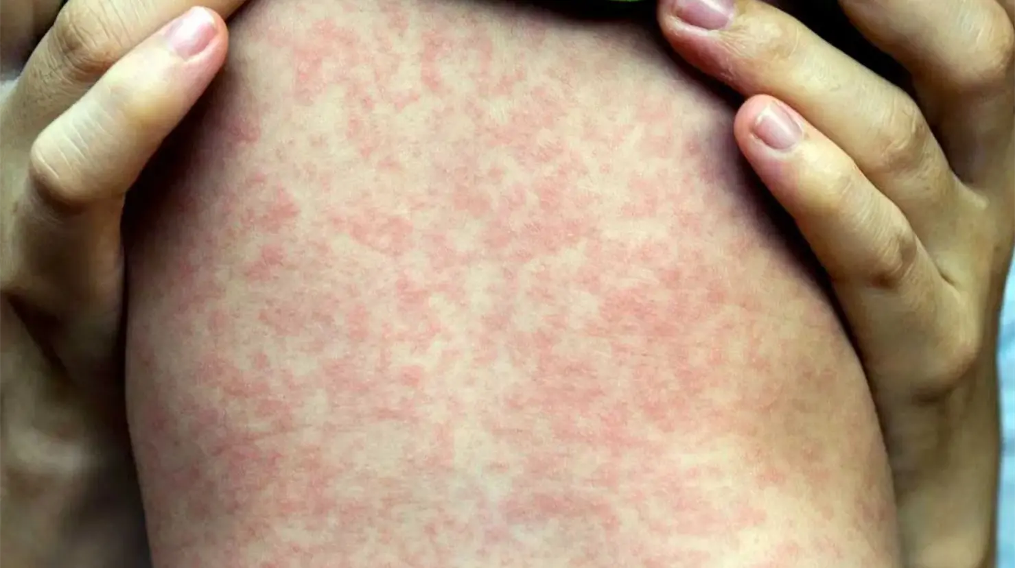 Confirman primera muerte por sarampión en CDMX; suman 28 a nivel nacional