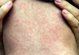 Confirman primera muerte por sarampión en CDMX; suman 28 a nivel nacional