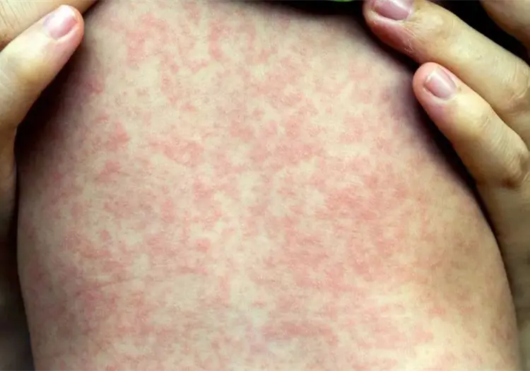 Confirman primera muerte por sarampi&oacute;n en CDMX; suman 28 a nivel nacional