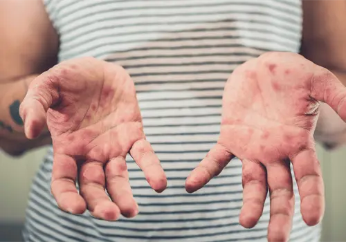 Sarampi&oacute;n en M&eacute;xico; ya van casi 2 mil 500 casos en 2026