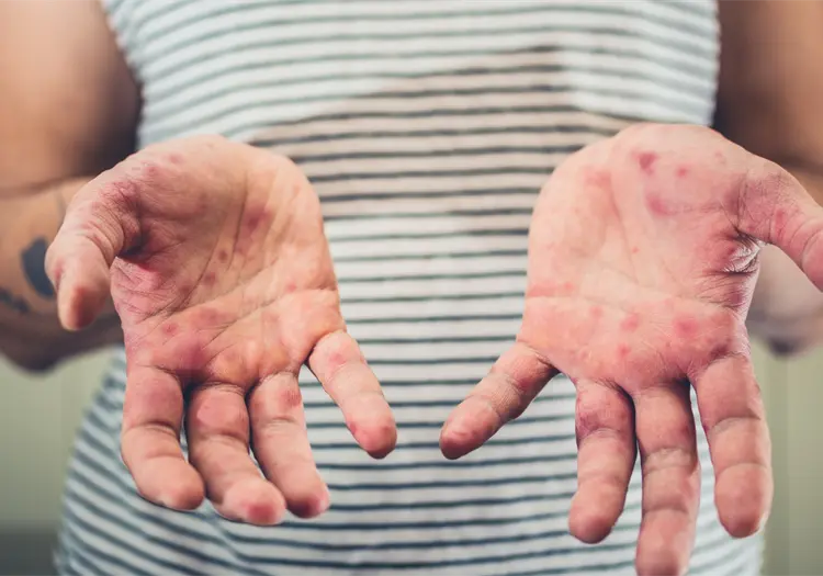 Sarampi&oacute;n en M&eacute;xico deja 28 muertes; los casos van en aumento